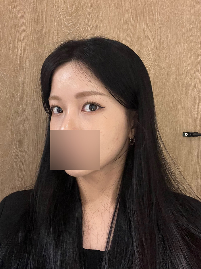 신사 얼굴지방이식 효과, 전후 비교 후기 관련 이미지 2