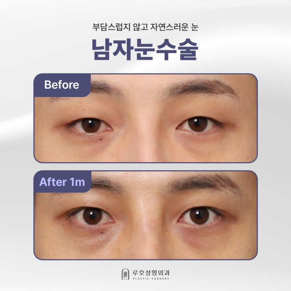 Men’s Eye Surgery at Sinsa Station: A Case of Correcting a Heavy-Looking Eye Shape image 1