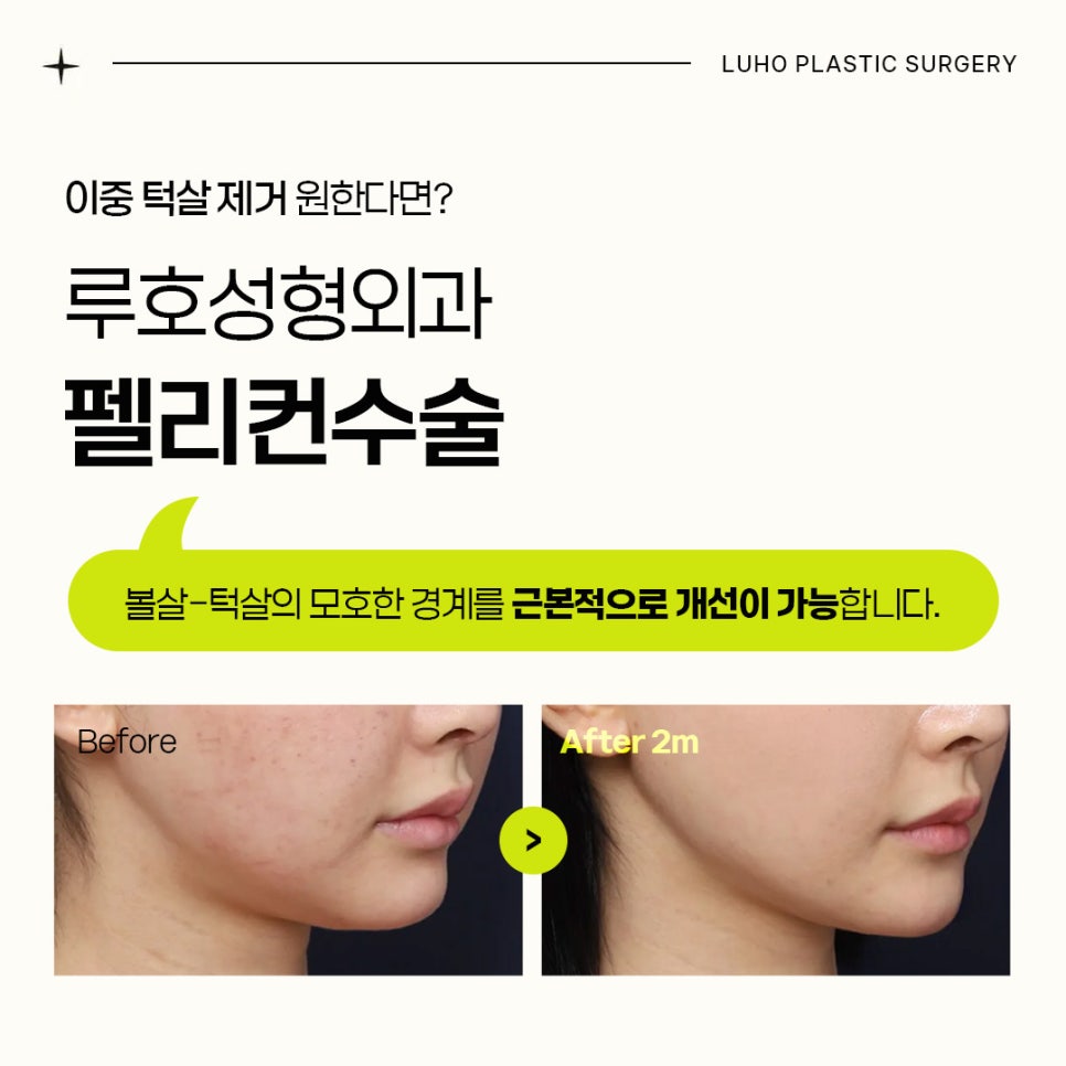 이중 턱살 제거한 신사역 펠리컨 수술 전후 관련 이미지 1