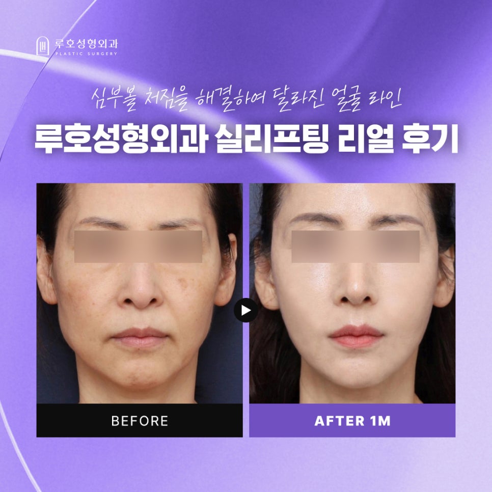 심부볼 처짐 고민 해결한 신사역 실리프팅 솔직 후기 관련 이미지 1