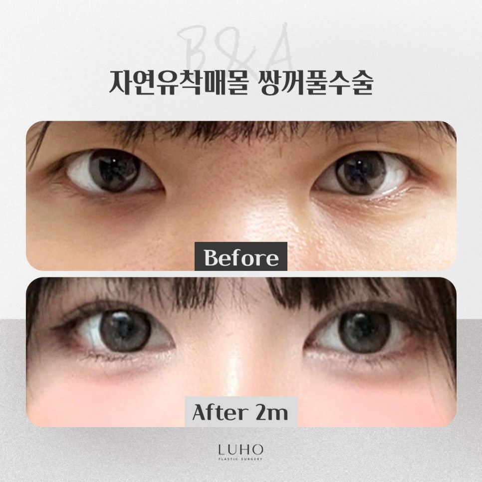 눈매에 또렷함에 집중한 신사역 쌍꺼풀 수술 결과 관련 이미지 1