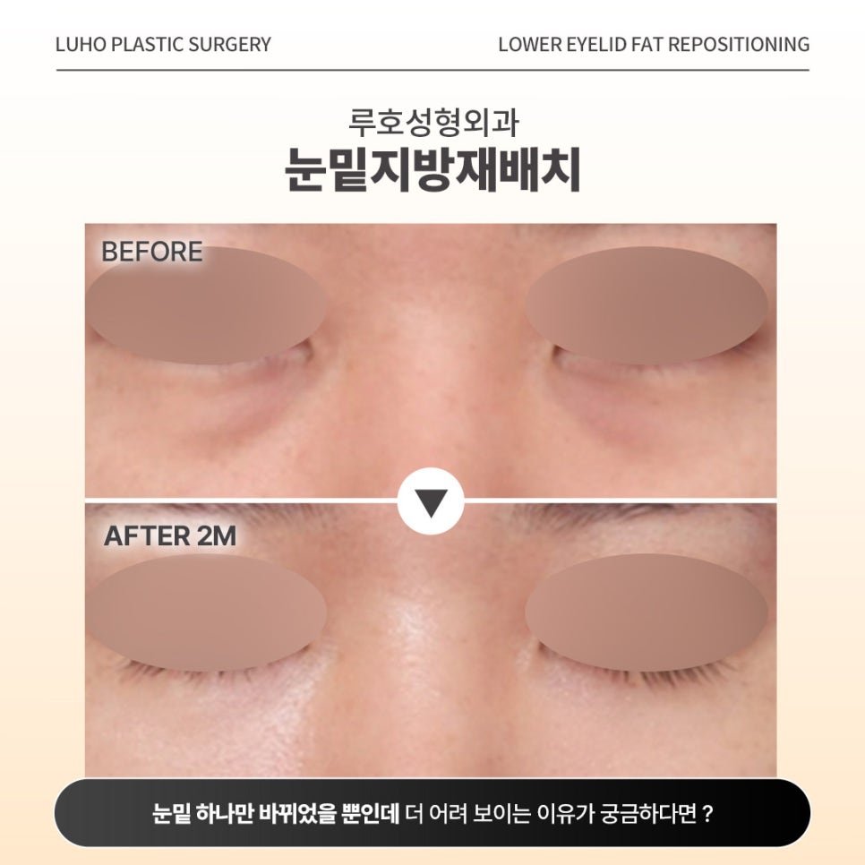 인상을 칙칙하게 만드는 다크서클 잡은 눈밑지 사례 관련 이미지 1
