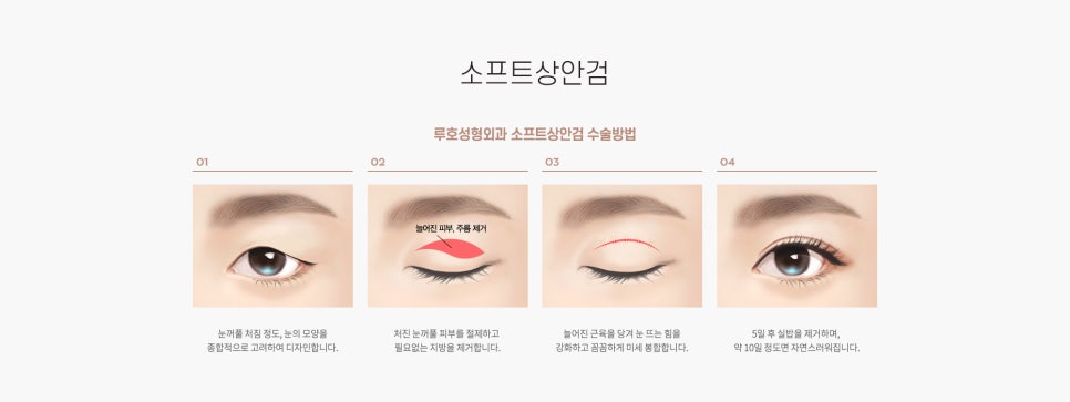 눈 수술법의 종류와 회복기간 #2 관련 이미지 1