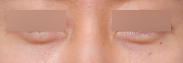 Effects of Male Under-Eye Fat Repositioning for a More Vibrant-Looking Eye Area image 5
