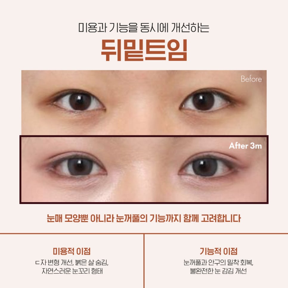 뒤밑트임 효과부터 수술 전 궁금증 Q&A 정리 관련 이미지 2