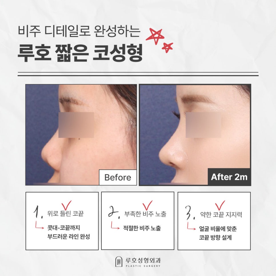 세련된 코로 변신한 짧은코성형 후기 살펴보기 관련 이미지 1