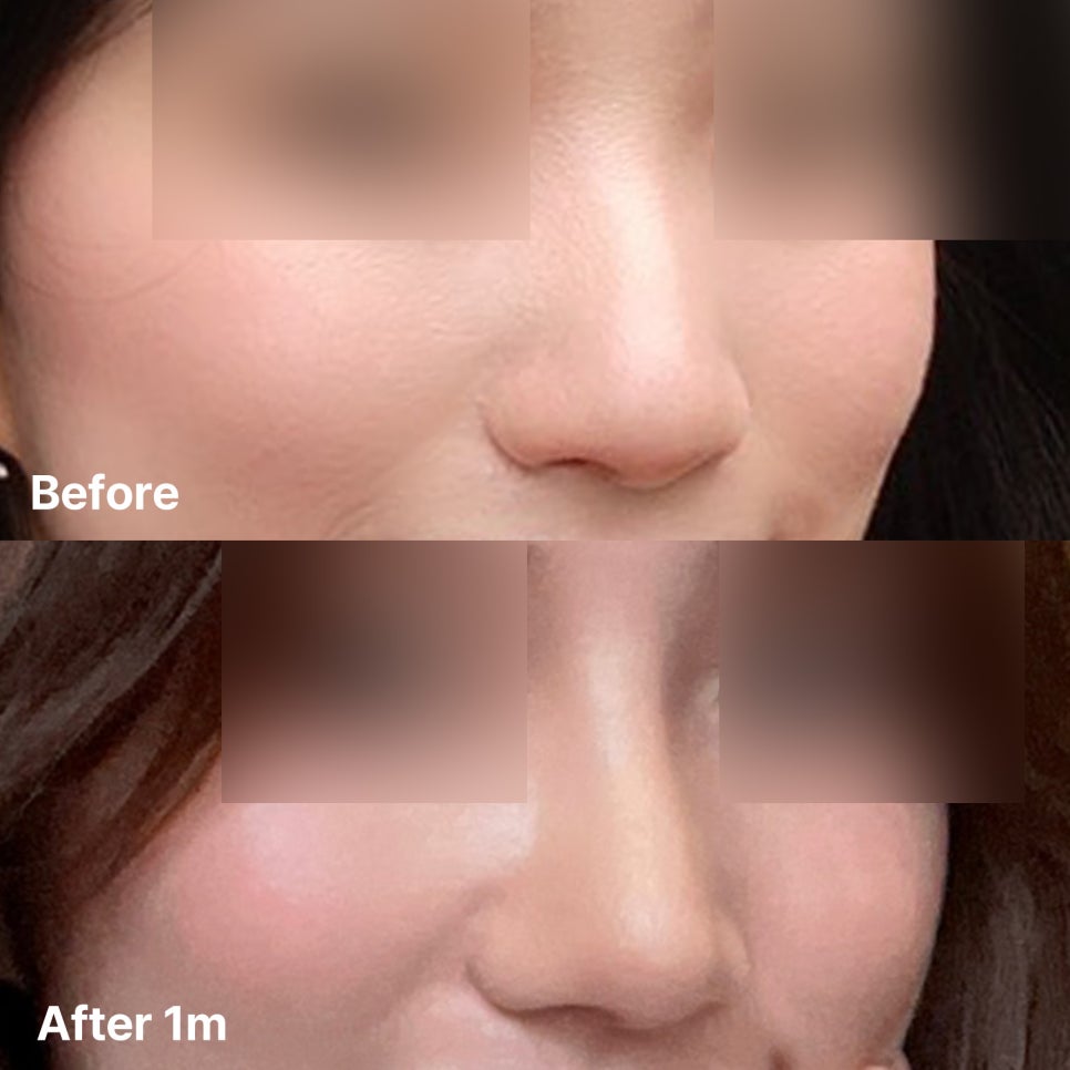 웃을 때 퍼져 보이는 코, 콧대부터 코끝까지 정리한 코수술 관련 이미지 1