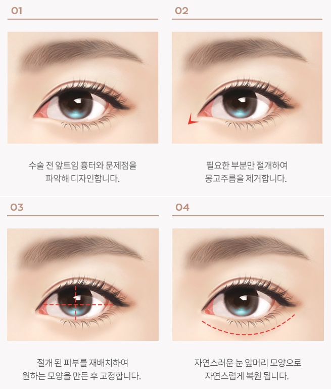 신사역 앞트임 복원, 언제 필요할까요? 관련 이미지 6