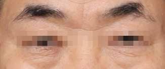 Curious About a Real Case of Lower Blepharoplasty for Under-Eye Sagging at Sinsa Station? image 2