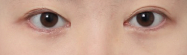 나에게 어울리는 눈매를 완성한 신사역 앞트임 복원 후기 관련 이미지 3