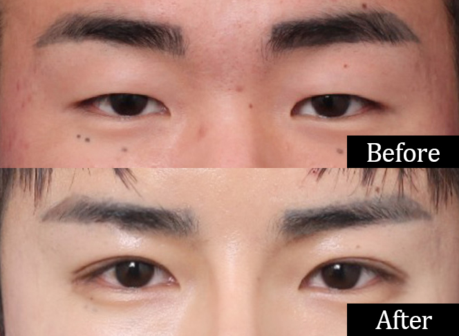 Sinsa Station: What’s the Difference Between Male Eye Surgery and Female Eye Surgery? image 7