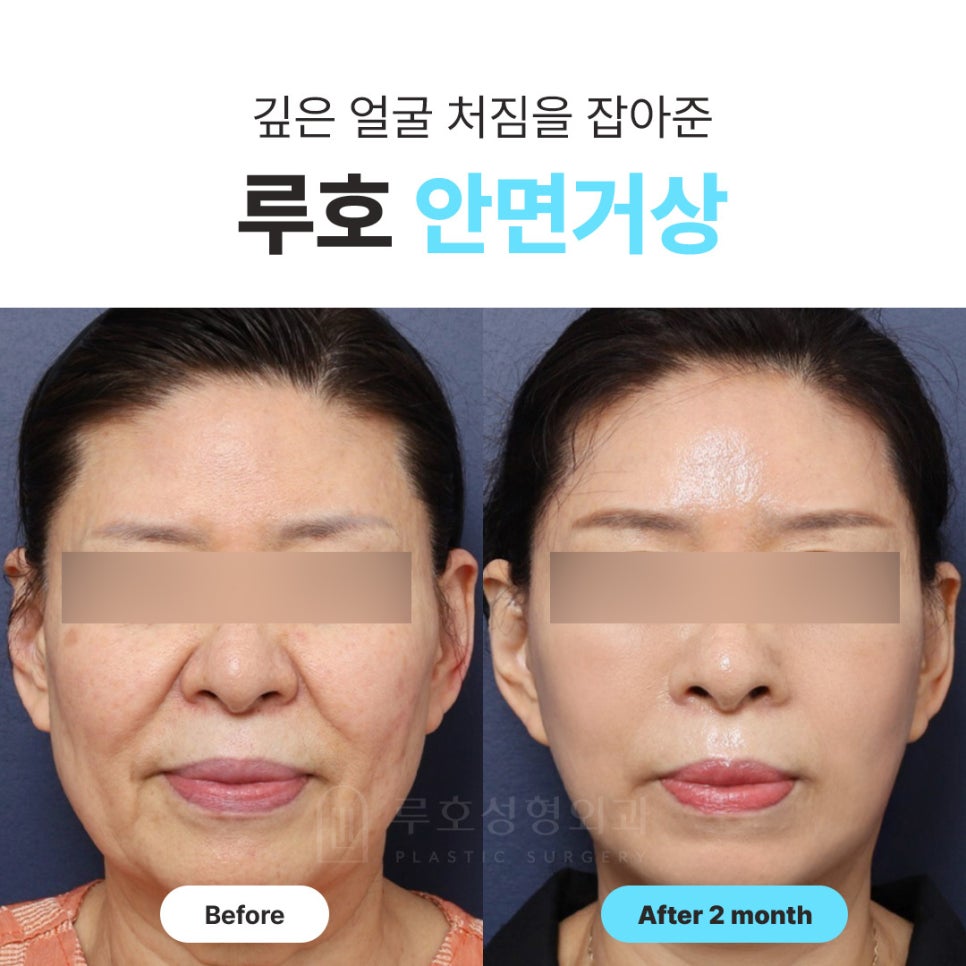 신사역 안면거상, 깊은 얼굴 처짐이 고민이라면 관련 이미지 1