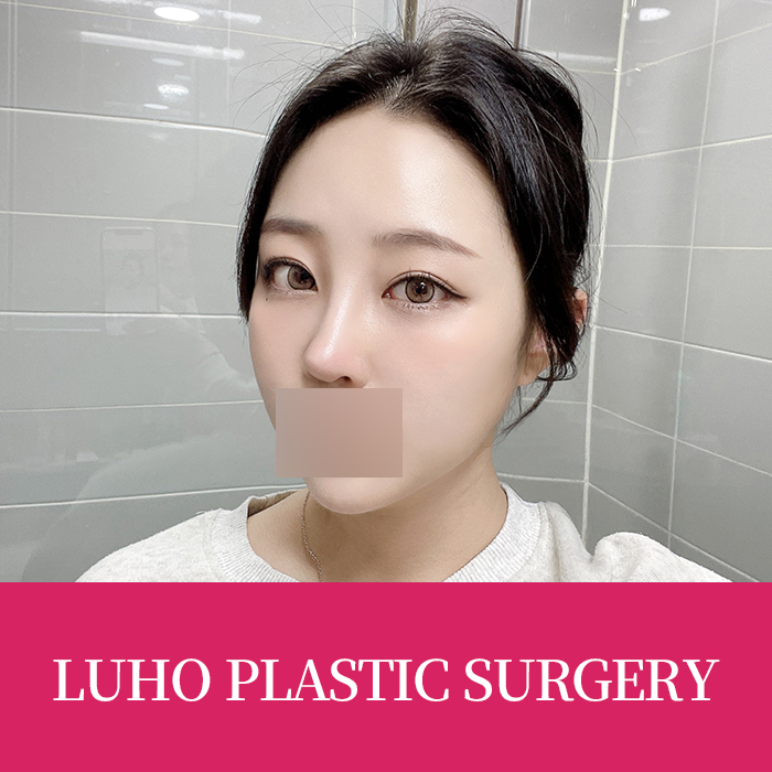 신사역 소시지 눈 재수술 성형외과 쌍꺼풀 전후 후기 관련 이미지 1