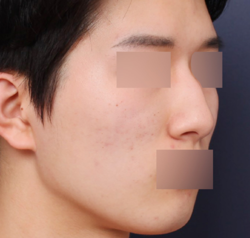 A Review of a Sinsa Station Clinic Known for Male Rhinoplasty That Created a Refined Image image 3