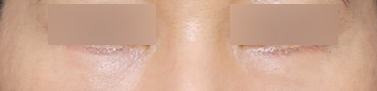 Sinsa Station Lower Blepharoplasty That Changed Heavy-Looking Under-Eyes image 5
