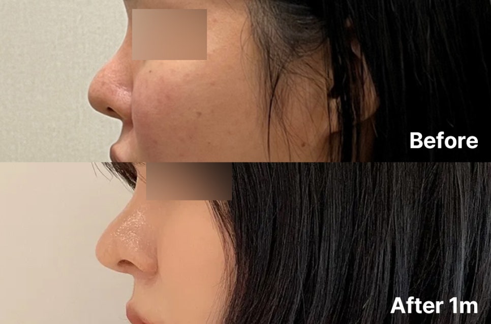 Redesigning a Bulbous Nose After 9 Years: Revision Rhinoplasty image 1