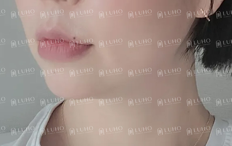 다이어트해도 안 빠지는 턱살, 이중턱 근육 묶기로 달라진 후기 관련 이미지 2