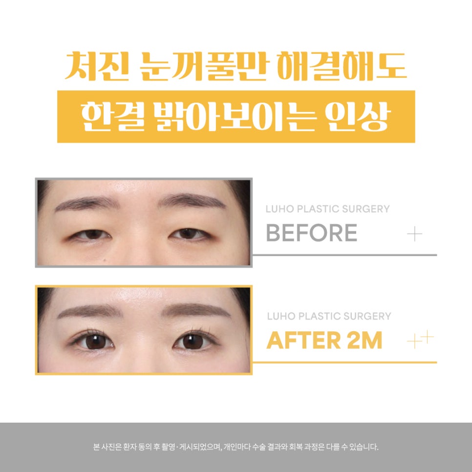 Before-and-After Review of Ptosis Correction with Double Eyelid Surgery Near Sinsa Station image 1