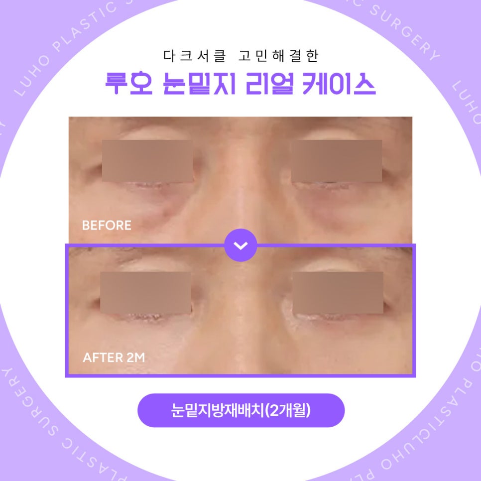 신사역 다크서클 고민, 루호성형외과에서 밝아진 눈매 후기 관련 이미지 1