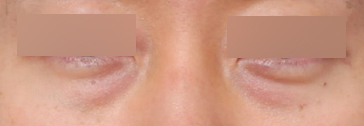Effects of Male Under-Eye Fat Repositioning for a More Vibrant-Looking Eye Area image 4