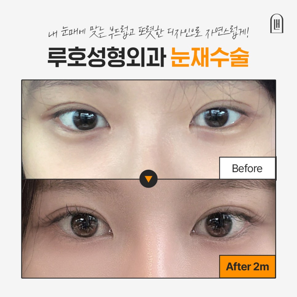 소시지 눈 재수술로 자연스럽고 또렷해진 눈매 관련 이미지 1