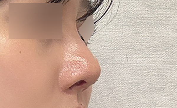 기존 이미지를 유지하면서 라인만 정돈한 코수술 관련 이미지 10