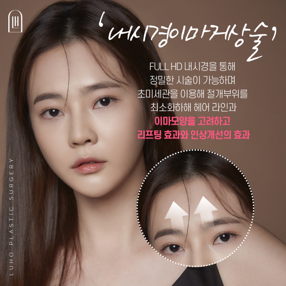 루호성형외과의 이마 거상술로 처진 눈과 리프팅효과까지! 관련 이미지 3
