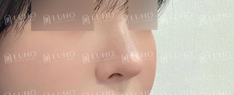 Redesigning a Bulbous Nose After 9 Years: Revision Rhinoplasty image 10