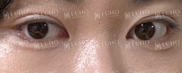눈꼬리의 답답한 공간을 열어 방향을 바꾼 뒤밑트임 관련 이미지 2