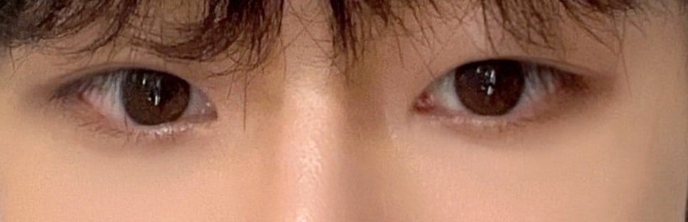 Review of Double Eyelid Surgery for Uneven Eyes at Sinsa Station for Men image 5