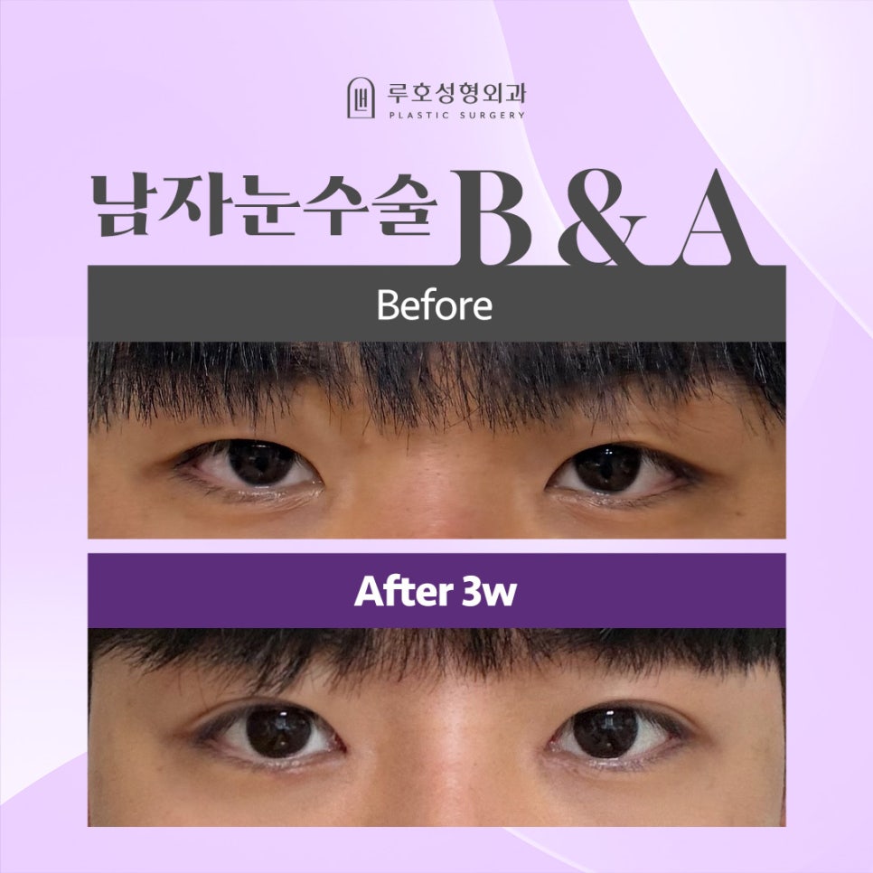 Review of Male Eye Surgery at Sinnonhyeon Station: Finding the Eye Shape That Suits Me image 1