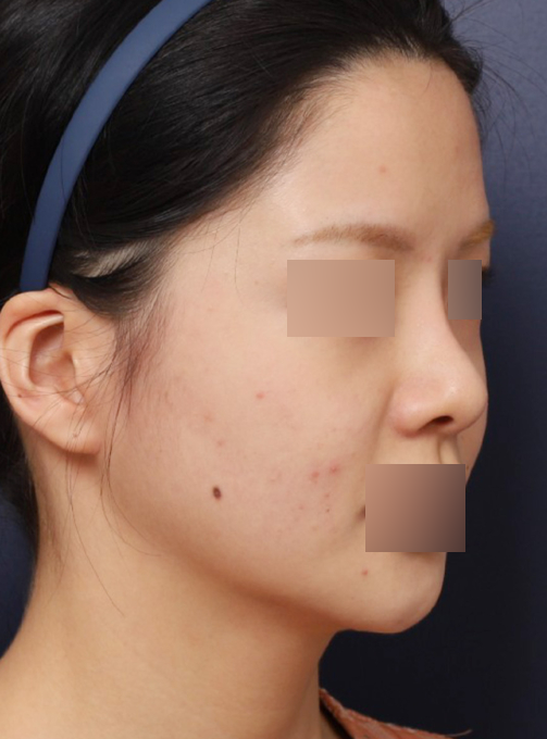 신사역 코 성형 재수술, 보형물 교체로 인위적인 콧대 개선 관련 이미지 3