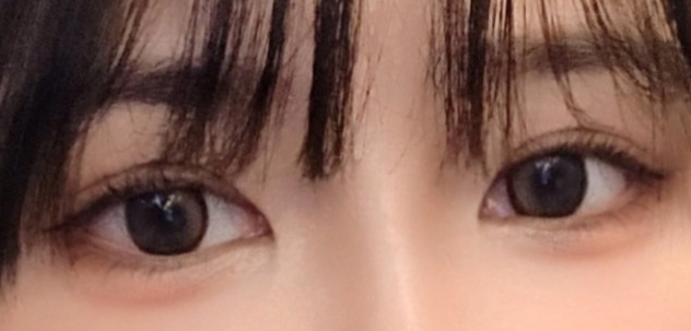 눈매에 또렷함에 집중한 신사역 쌍꺼풀 수술 결과 관련 이미지 4