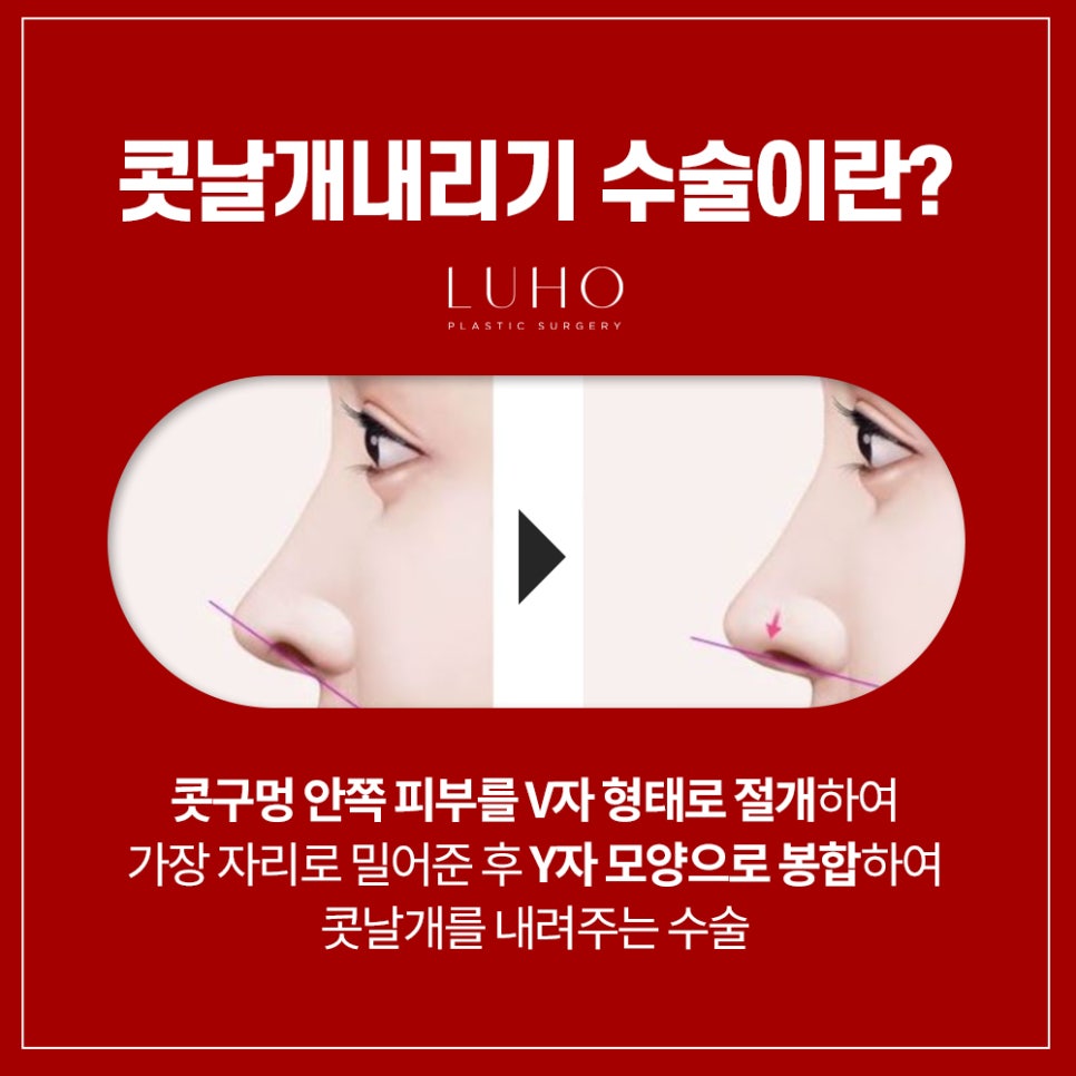 콧날개는 Down! 외모는 Up! 관련 이미지 2