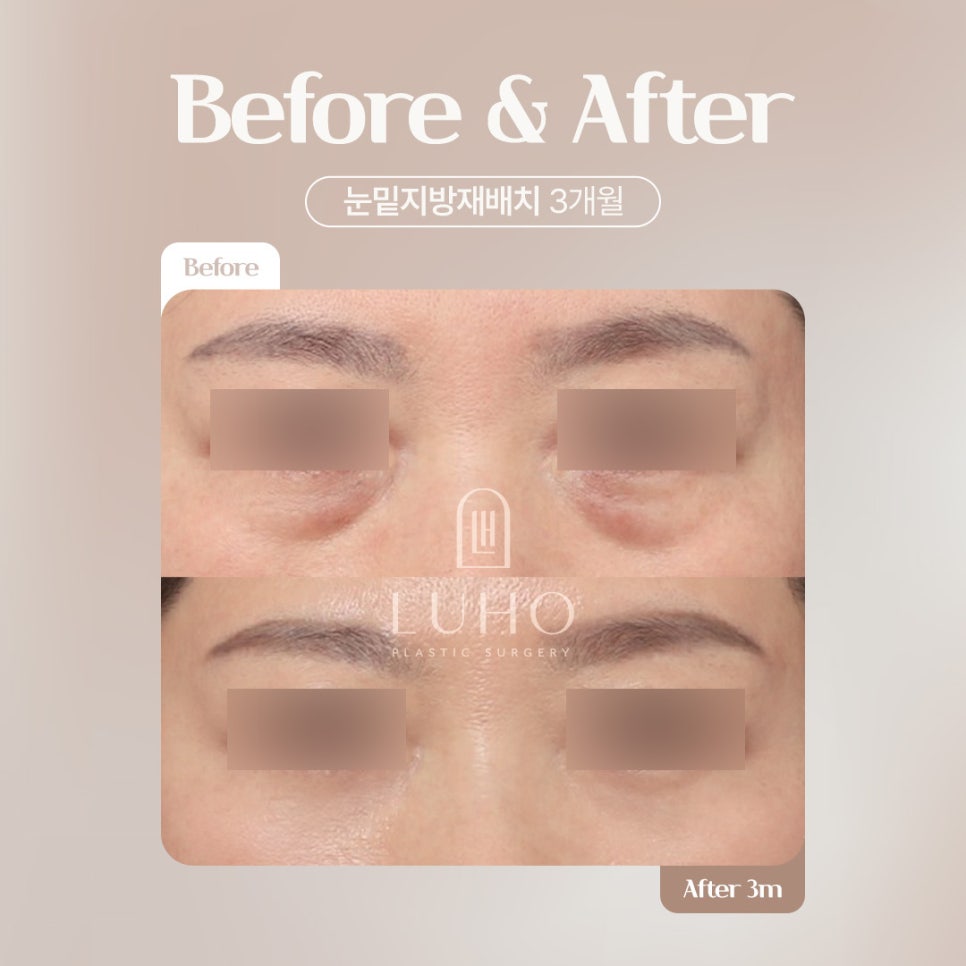 루호성형외과 눈밑지방재배치 관련 이미지 2