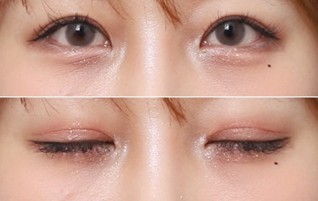 신사역 눈재수술, 절개눈매교정과 눈위지방이식으로 또렷해진 눈매 관련 이미지 5