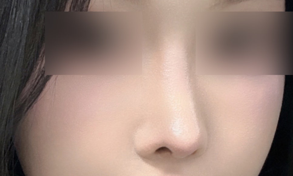 원인과 구조를 파악한 여자 코재수술 사례 살펴보기 관련 이미지 5