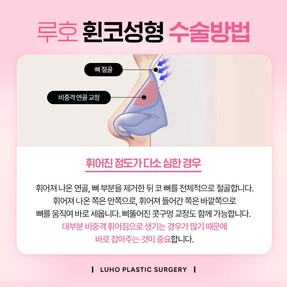 휘어진 코를 바르게 신사역 휜코수술 후기 관련 이미지 3