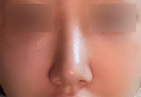 직반라인으로 디자인해 또렷한 존재감을 더한 코수술 효과 관련 이미지 4