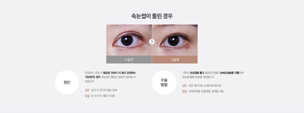 눈 수술법의 종류와 회복기간 #2 관련 이미지 9