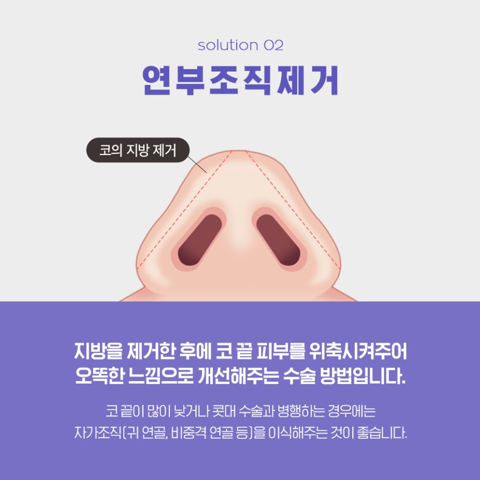 If You’re 고민 About Bulbous Nose Surgery, You Need to Know the Surgical Methods by Type image 5