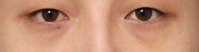 Men’s Eye Surgery at Sinsa Station: A Case of Correcting a Heavy-Looking Eye Shape image 3