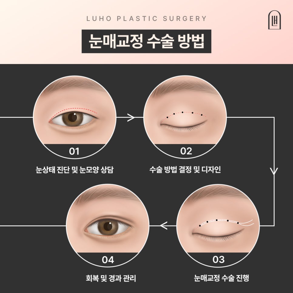 첫인상을 바꾼 눈매 변화, 신사역 여자눈성형 사례 관련 이미지 4
