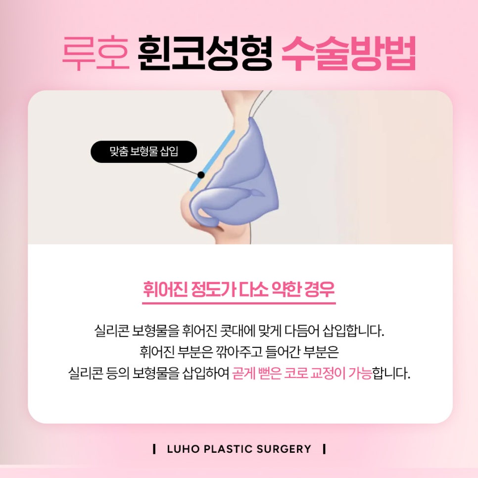 휘어진 코를 바르게 신사역 휜코수술 후기 관련 이미지 2