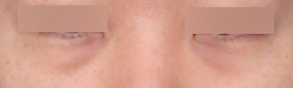 Effect of Under-Eye Fat Repositioning at Sinsa Station: A Reduced Dark Circle Appearance image 4