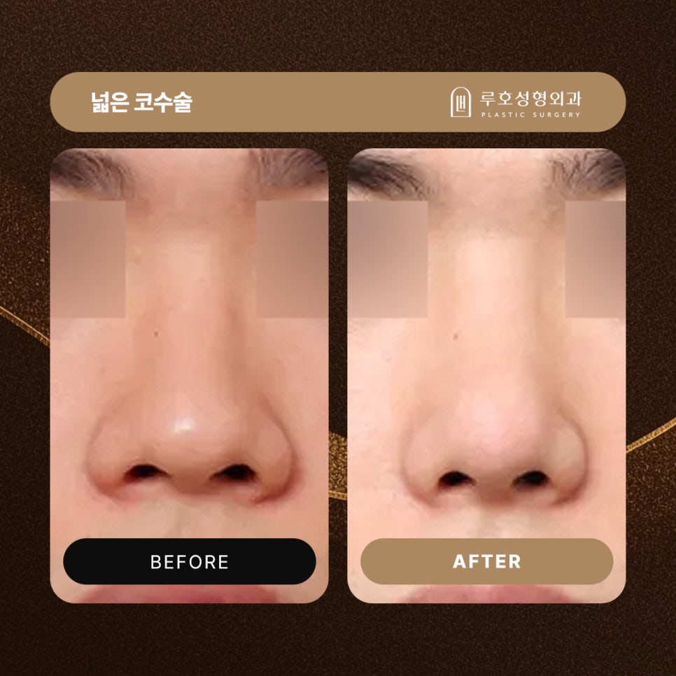 Shinsa Station Wide Nose Surgery, Center Line Neatened with Bridge Correction image 1