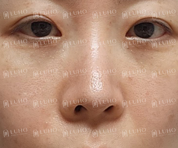 A Review of Eye & Nose Revision Surgery That Addressed the Shortcomings of Previous Surgery image 2