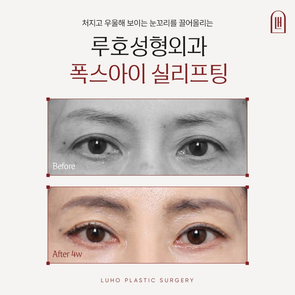 Real Patient Review: Eye-Corner Thread Lifting for a More Open, Defined Look image 1