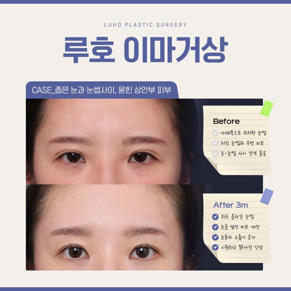 A Brighter Impression with an Endoscopic Forehead Lift to Correct Drooping Eyebrows image 1