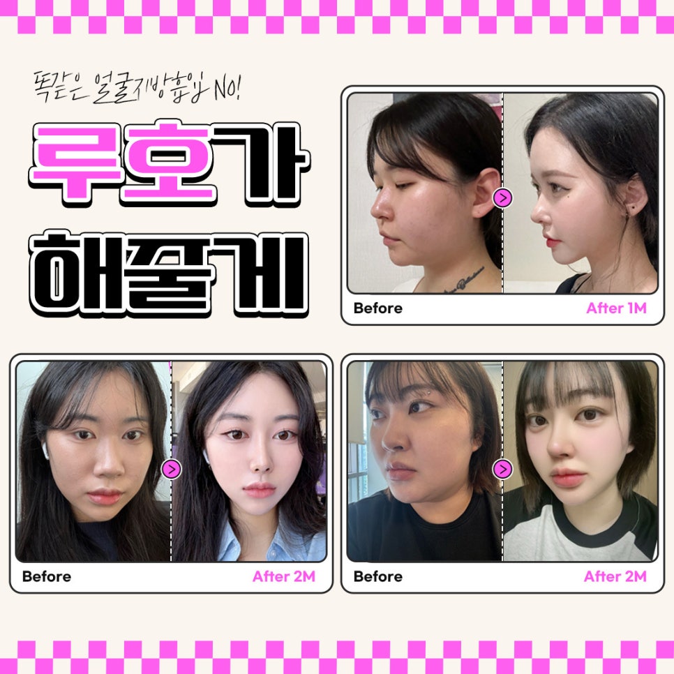 Large-Volume Facial Liposuction at Ruho Plastic Surgery image 2